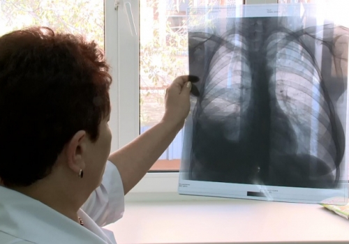 Омич с открытой формой туберкулёза полгода разгуливал без наблюдения врачей